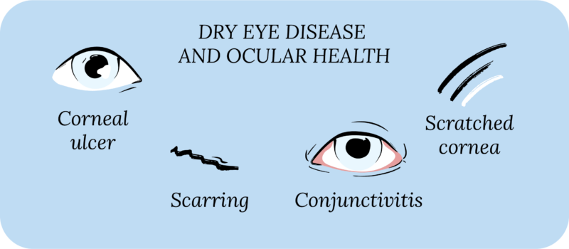 Complications Of Dry Eye Disease Corneacare Eyecare Made Easy