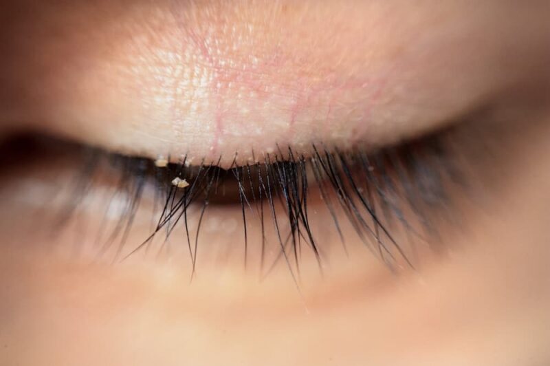 Blepharitis from Eyelash Extensions Tips & Relief CorneaCare
