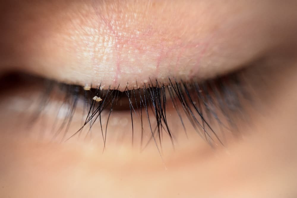 blepharitis crusty flakes on eyelashes