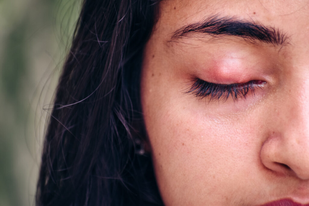 mosquito bite on eyelid of woman with dark hair